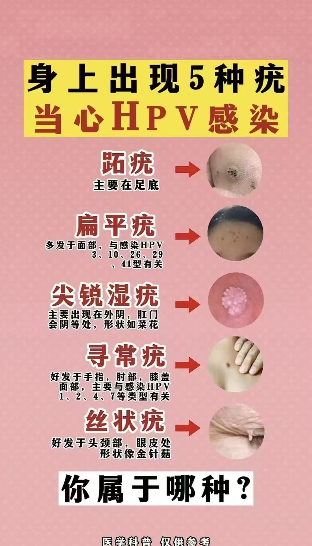 尖锐湿疣怎么治疗才能根治_(尖锐湿疣怎么治疗才能根治口腔)