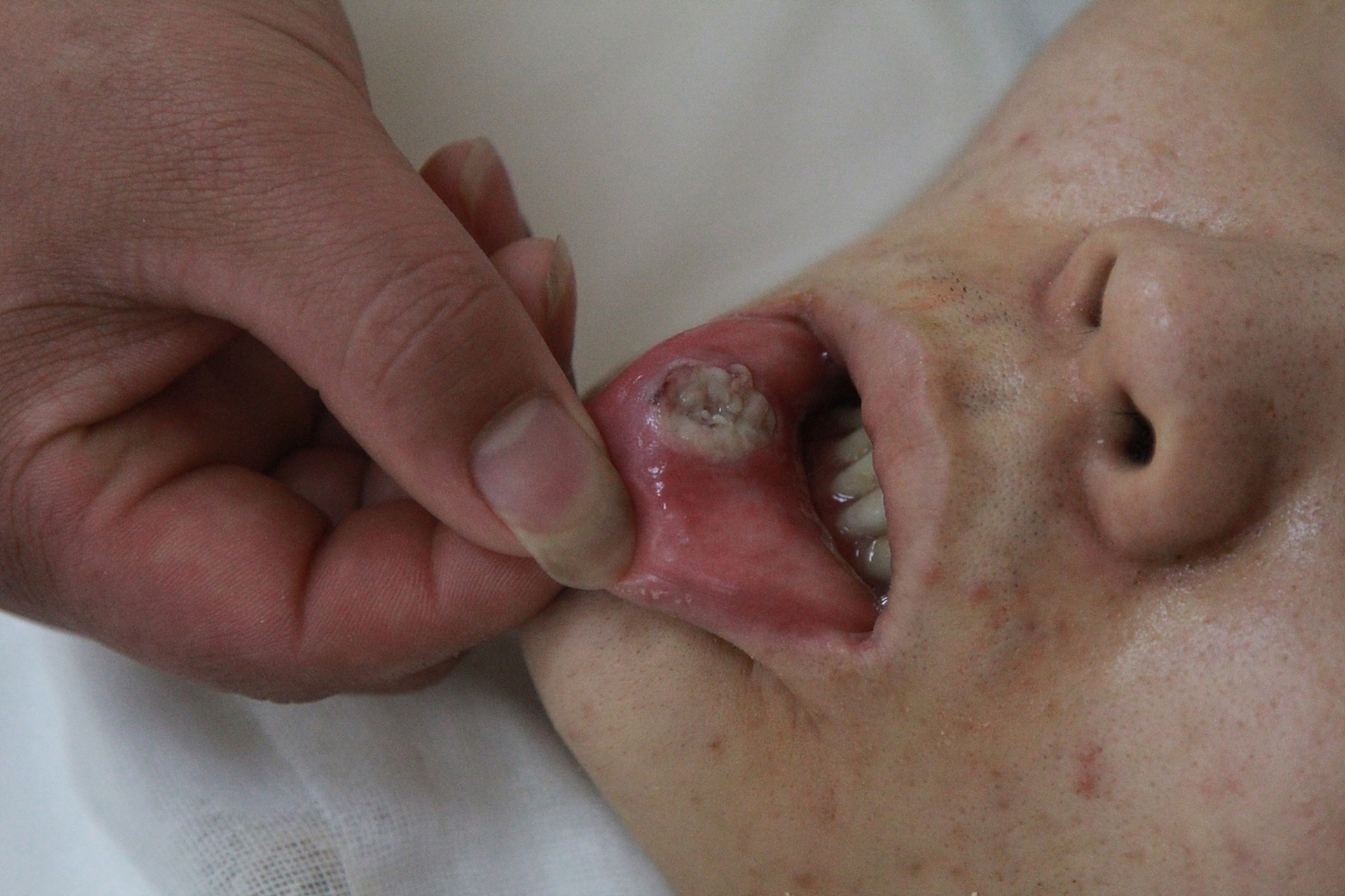 尖锐湿疣怎么治疗才能根治口腔_(尖锐湿疣怎么治疗才能根治口腔溃疡)